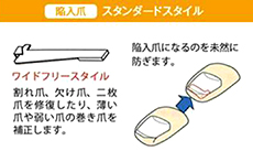 巻き爪補正スタンダードスタイルの図解