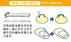 巻き爪補正フリースタイルの図解